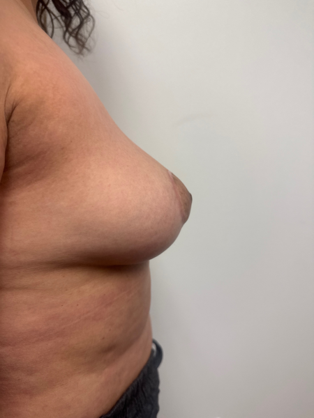 After Image: Breast Lift - back