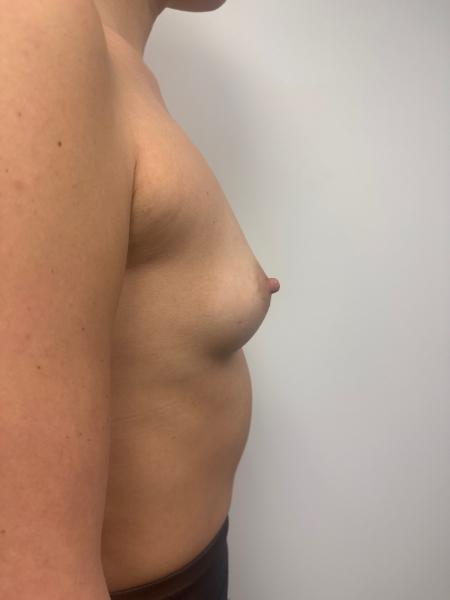 Before Image: Breast Augmentation - front