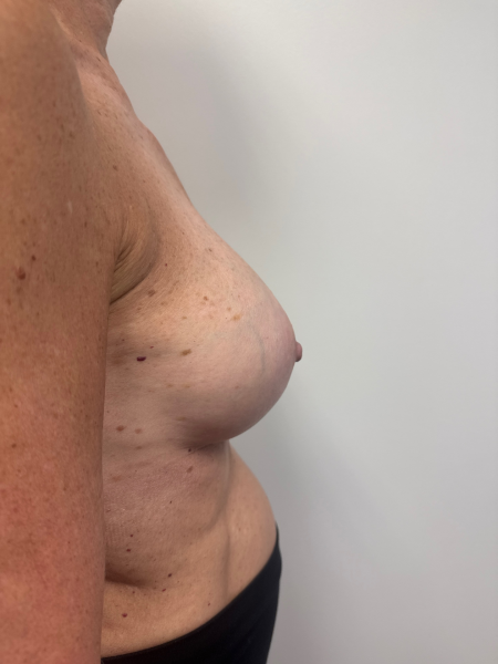 After Image: Breast Augmentation - back