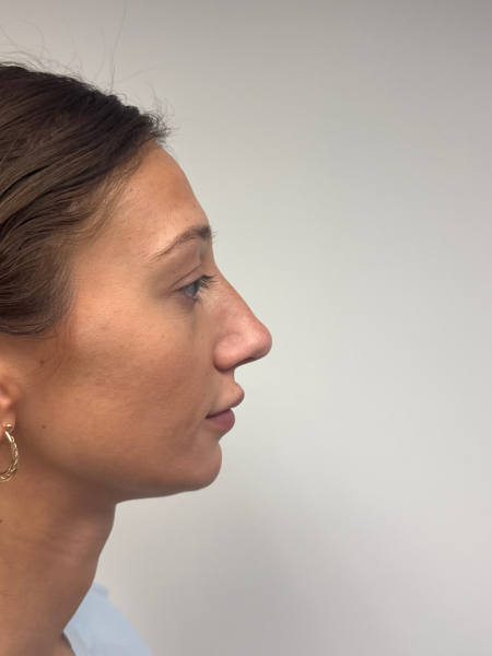 Before Image: Rhinoplasty - front