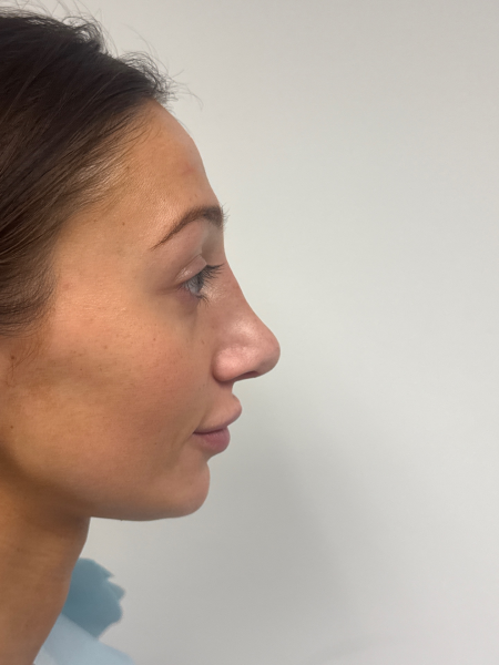After Image: Rhinoplasty - front