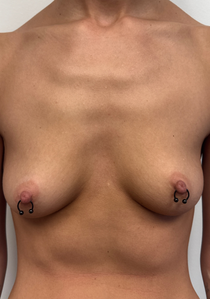Before Image: Breast Augmentation - front