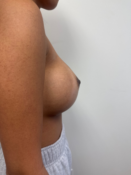 After Image: Breast Augmentation - right-side