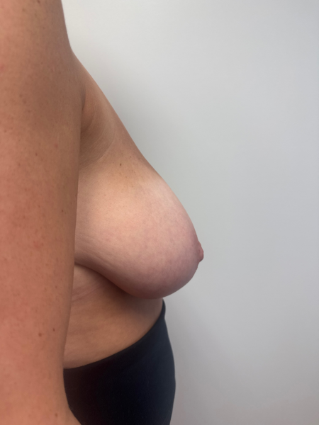 Before Image: Breast Reduction - back