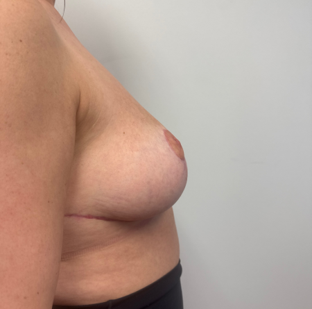 After Image: Breast Reduction - back