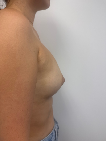 Before Image: Breast Augmentation - back