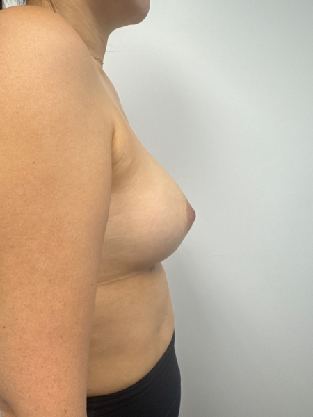After Image: Breast Augmentation - back