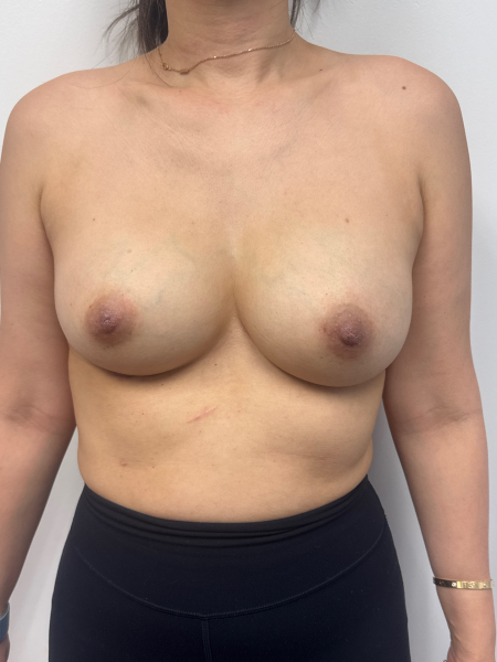 After Image: Breast Augmentation - front