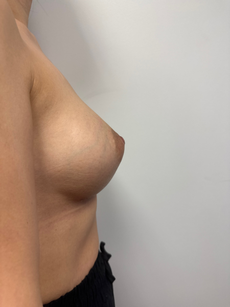 After Image: Breast Augmentation - back