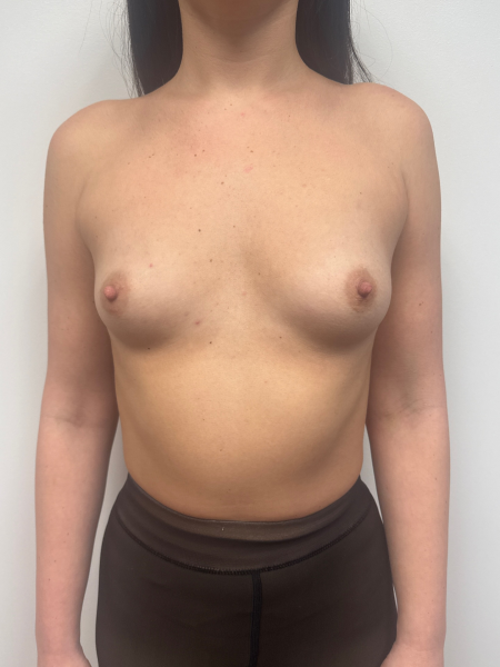 Before Image: Breast Augmentation - front