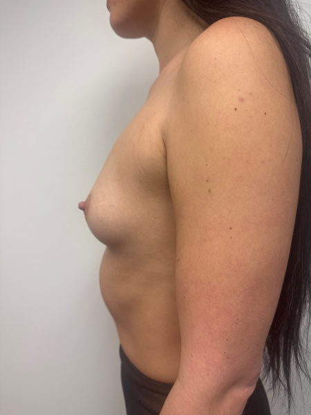 Before Image: Breast Augmentation - back
