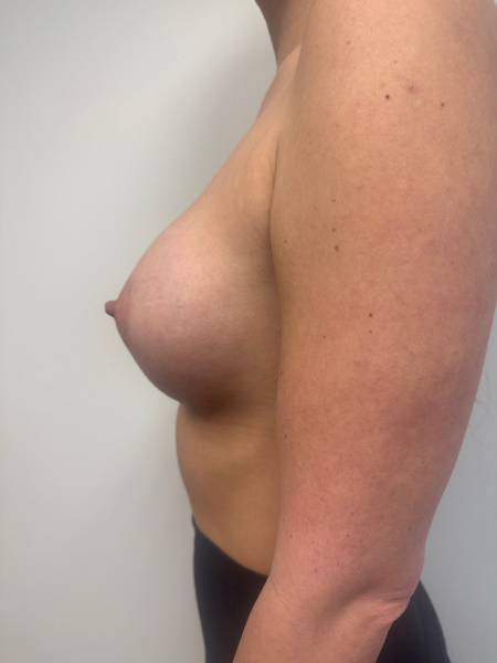 After Image: Breast Augmentation - back