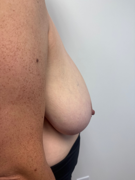 Before Image: Breast Reduction - back