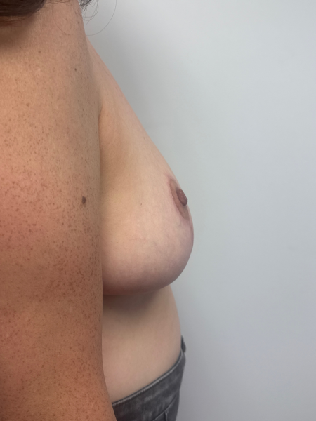 After Image: Breast Reduction - back