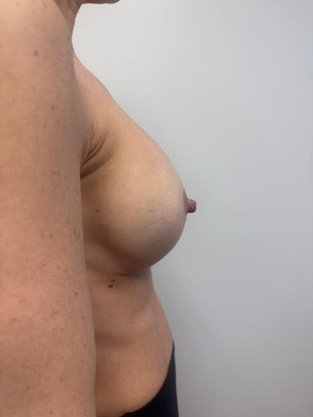 After Image: Breast Augmentation - back