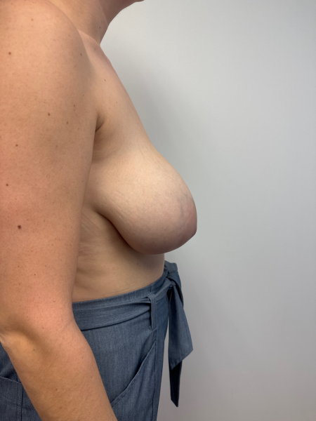 Before Image: Breast Reduction - back
