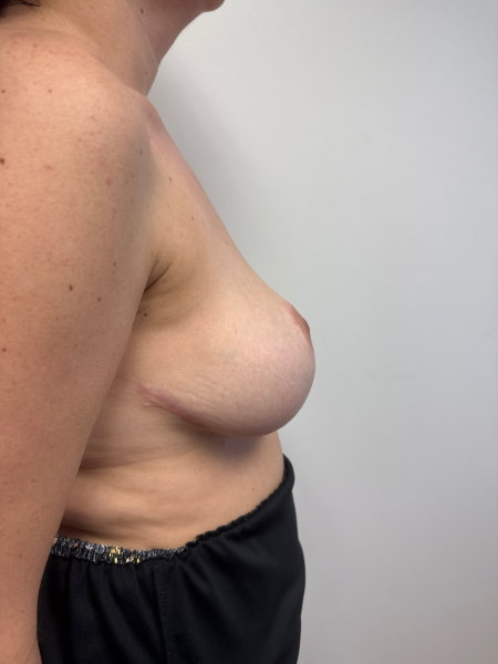 After Image: Breast Reduction - back
