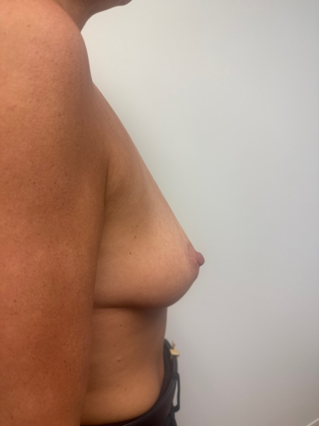 Before Image: Breast Augmentation - back