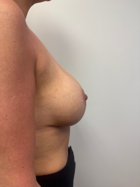 After Image: Breast Augmentation - back