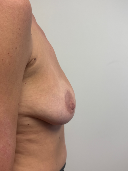 Before Image: Breast Augmentation - back