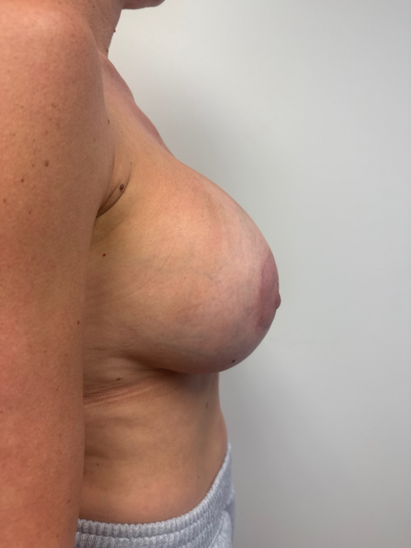 After Image: Breast Augmentation - back