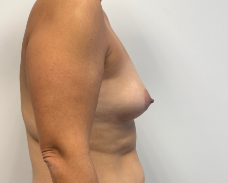 Before Image: Mommy Makeover - back
