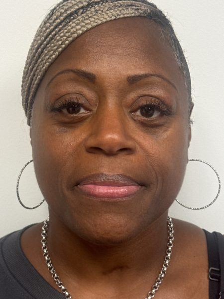 After Image: Blepharoplasty - front