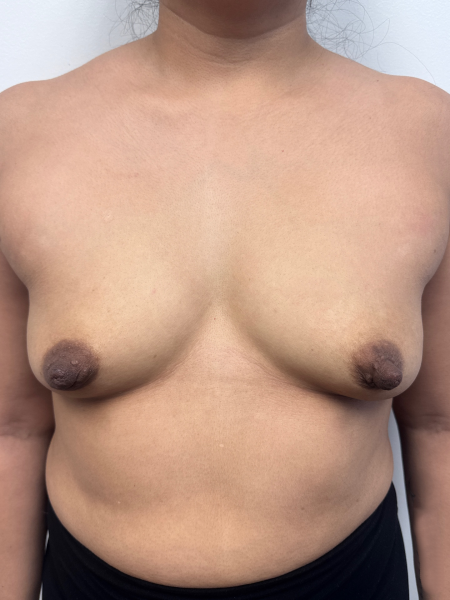 Before Image: Breast Augmentation - front