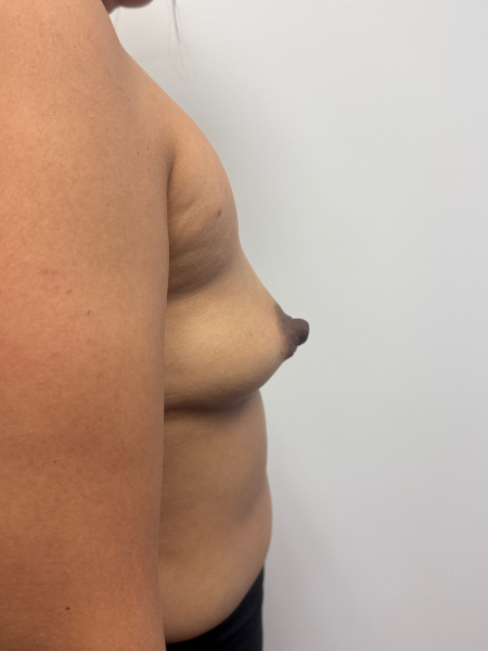 Before Image: Breast Augmentation - back