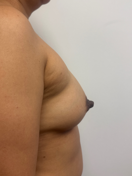 After Image: Breast Augmentation - back