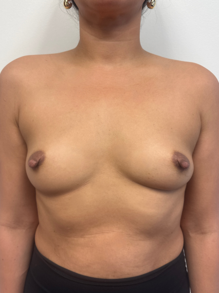 Before Image: Breast Augmentation - front