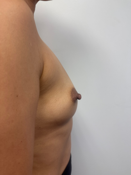 Before Image: Breast Augmentation - back