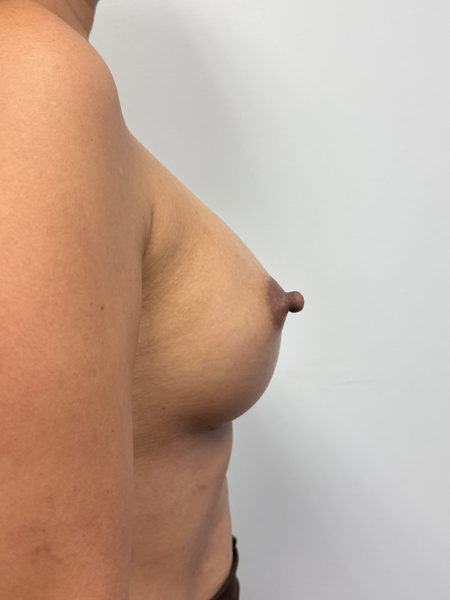 After Image: Breast Augmentation - back
