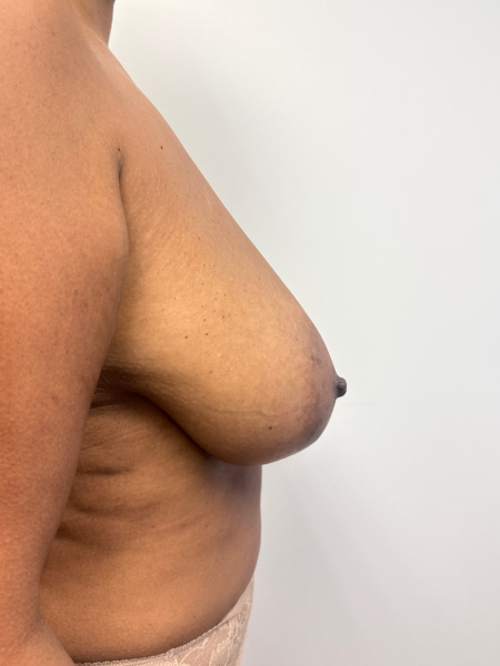 Before Image: Breast Lift - back