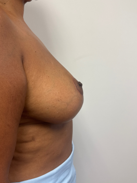 After Image: Breast Lift - back