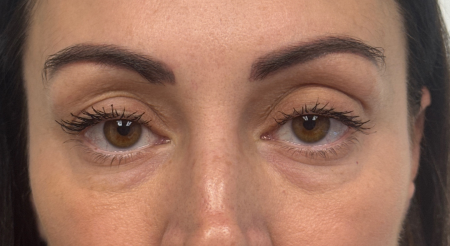 Before Image: Blepharoplasty - front