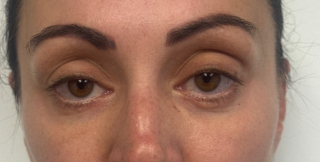 After Image: Blepharoplasty - front