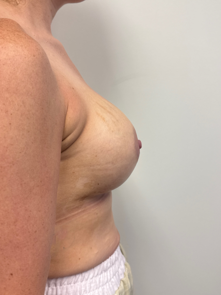 After Image: Breast Augmentation - back