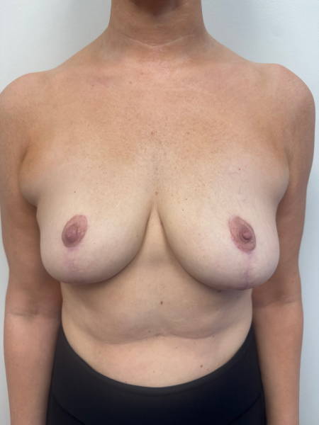 After Image: Breast Reduction - front