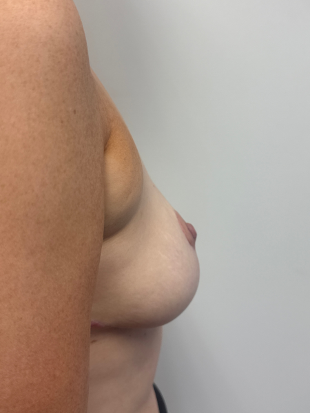 After Image: Breast Reduction - back