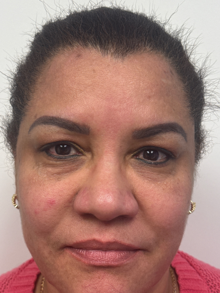 Before Image: Blepharoplasty - front