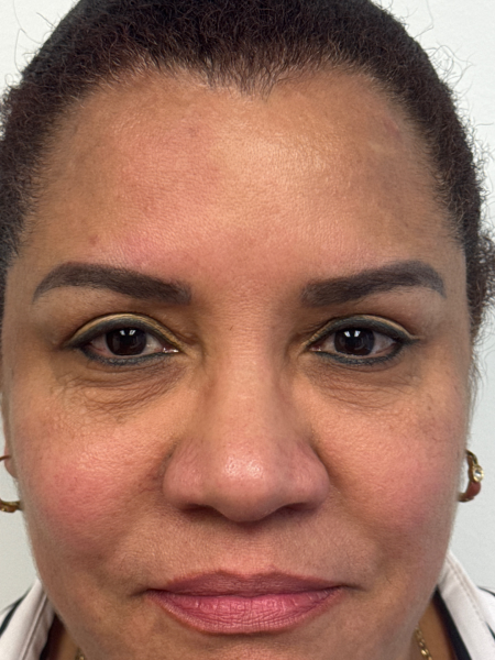 After Image: Blepharoplasty - front