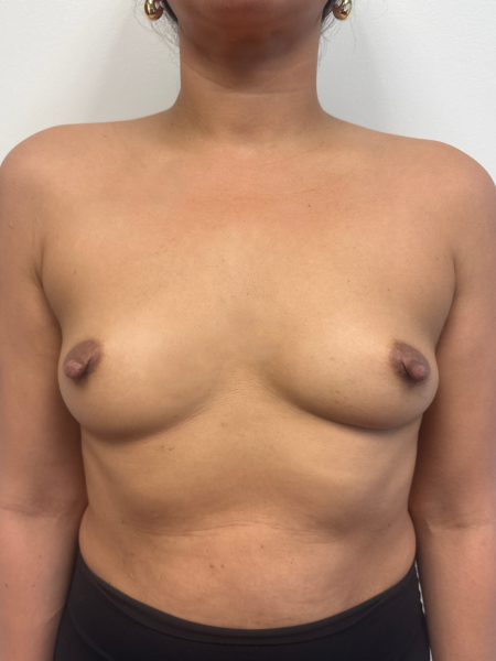 Before Image: Breast Augmentation - front