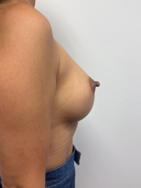 After Image: Breast Augmentation - back