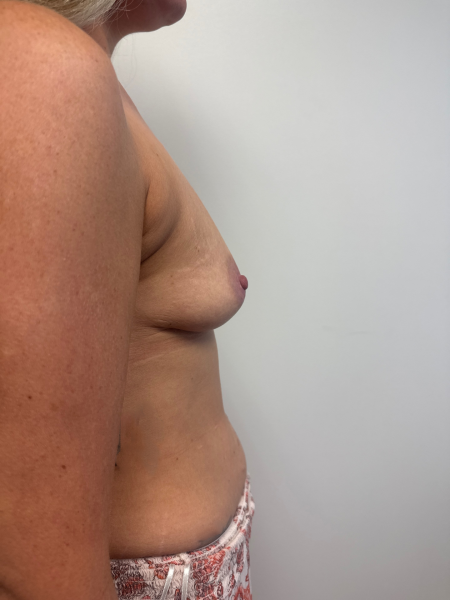 Before Image: Breast Augmentation - back