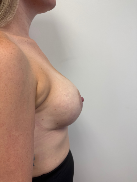 After Image: Breast Augmentation - back