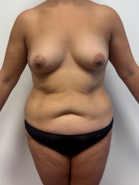 Before Image: Mommy Makeover - front
