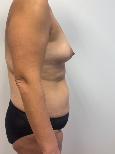 Before Image: Mommy Makeover - back
