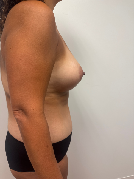 After Image: Mommy Makeover - back