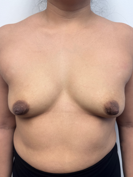 Before Image: Breast Augmentation - front